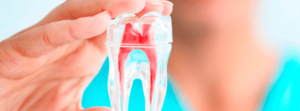 afeto-odontologia-recomendacoes-endodontia